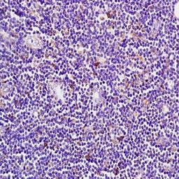 Immunohistochemical analysis of formalin-fixed and paraffin embedded human pancreas carcinoma tissue (Dilution at:1:200) using RIP3 antibody