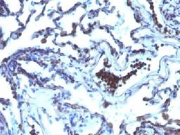 Immunohistochemical staining of human Lung Carcinoma tissue using TDP2 antibody