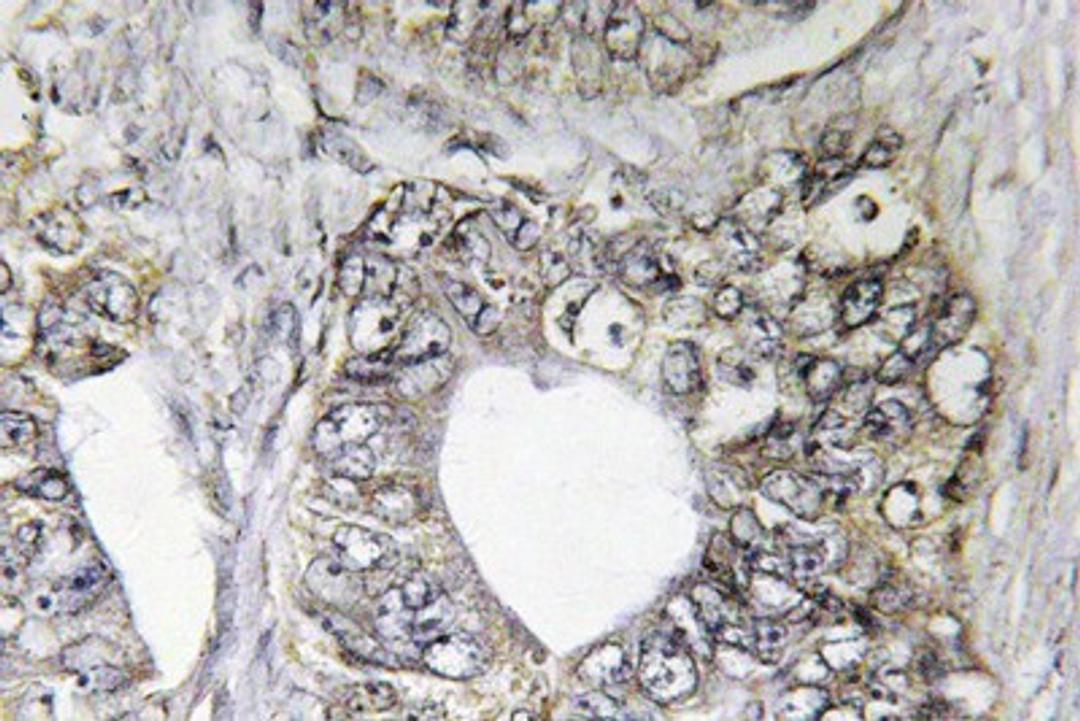 Immunohistochemistry-Paraffin: JNK1/2/3 Antibody [NBP1-19872] Human colon carcinoma tissue.