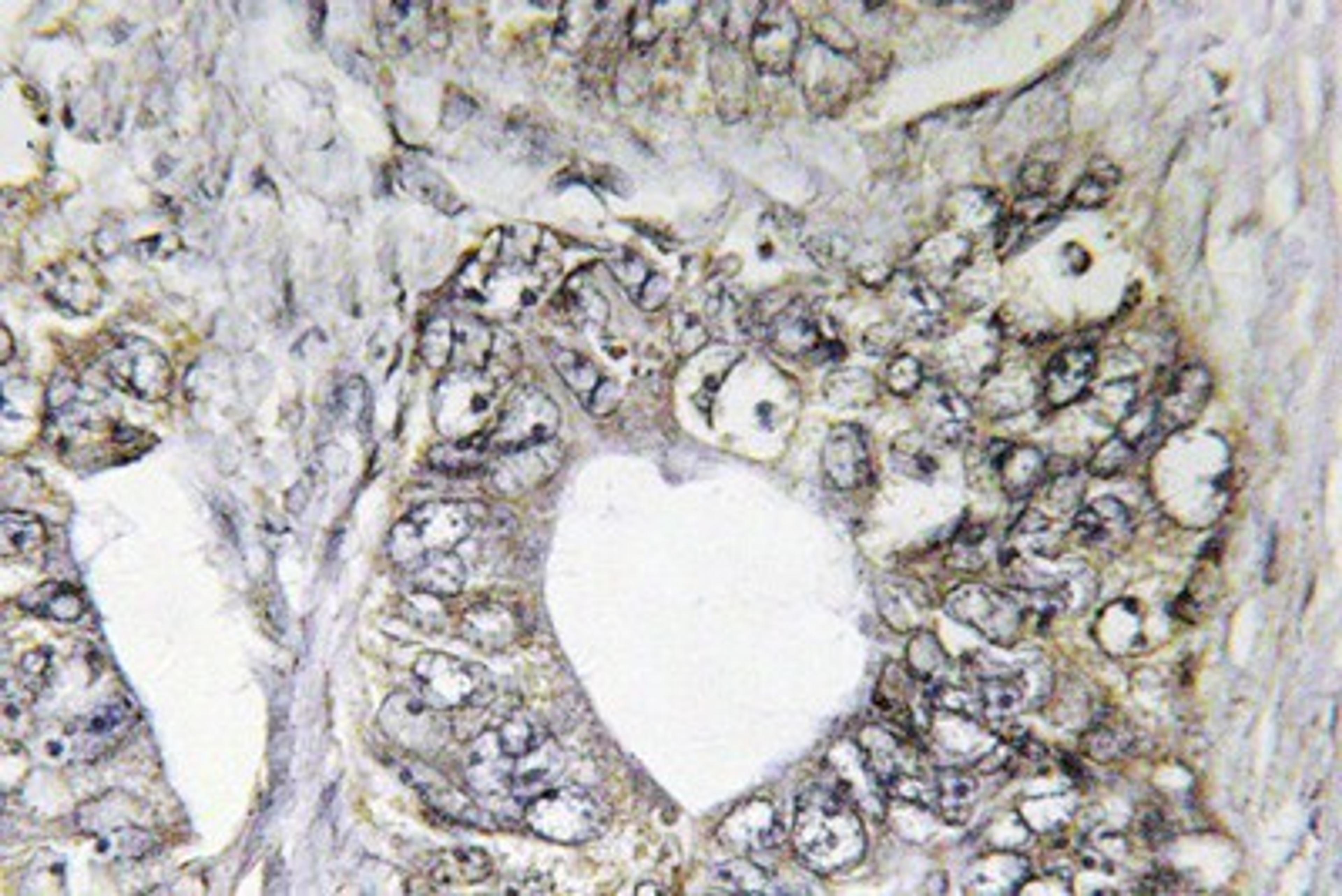 Immunohistochemistry-Paraffin: JNK1/2/3 Antibody [NBP1-19872] Human colon carcinoma tissue.