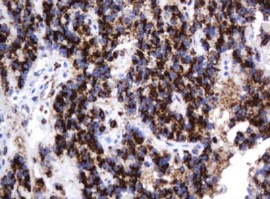 Immunohistochemistry: beta-Galactosidase-1/GLB1 Antibody (1C9) [NBP2-45731] - Analysis of Carcinoma of Human pancreas tissue. (Heat-induced epitope retrieval by 10mM citric buffer, pH6.0, 120C for 3min)