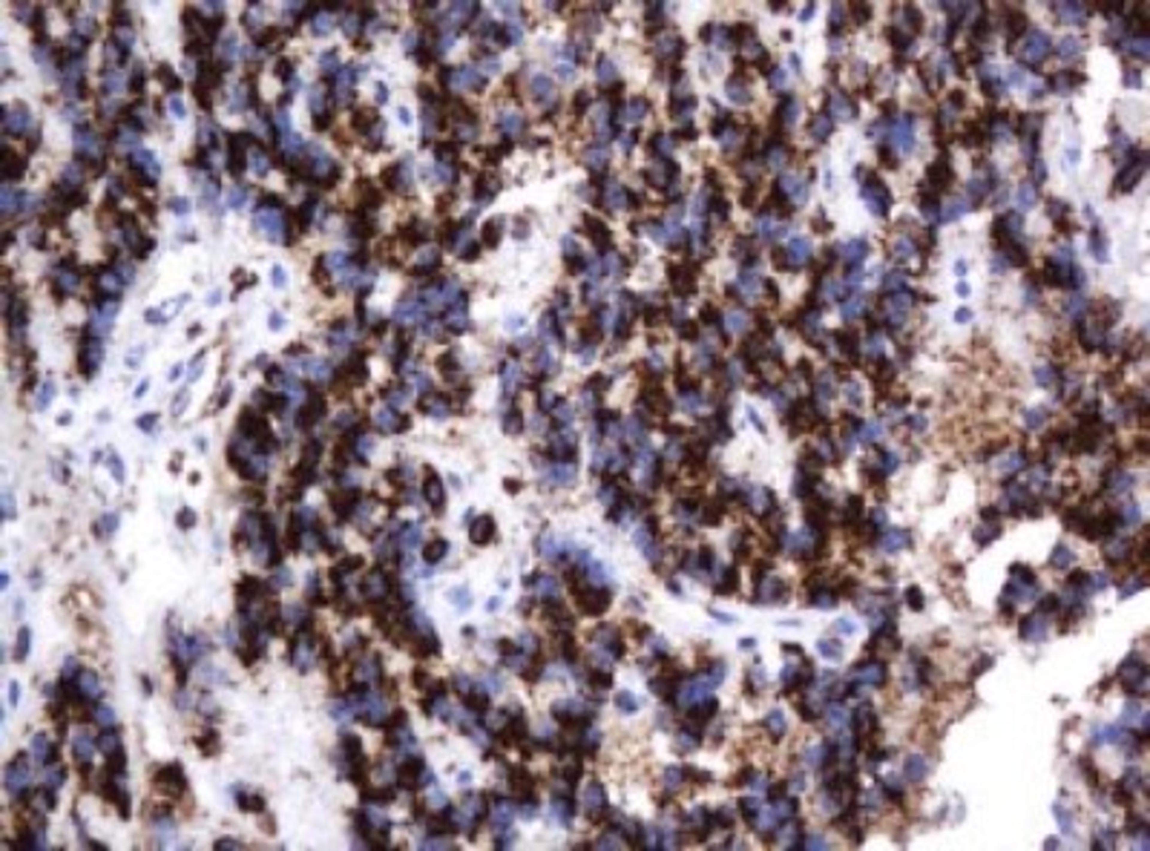 Immunohistochemistry: beta-Galactosidase-1/GLB1 Antibody (1C9) [NBP2-45731] - Analysis of Carcinoma of Human pancreas tissue. (Heat-induced epitope retrieval by 10mM citric buffer, pH6.0, 120C for 3min)