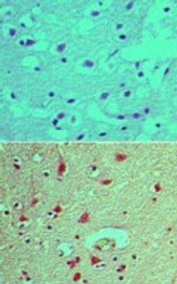 Immunohistochemistry-Paraffin: INPPL1 [p Tyr497] Antibody [NBP2-24461] - analysis of phosphorylated SHIP2 in formalin-fixed, paraffin-embedded human brain tissue using an isotype control (top) and this antibody (bottom) at 5 ug/ml.