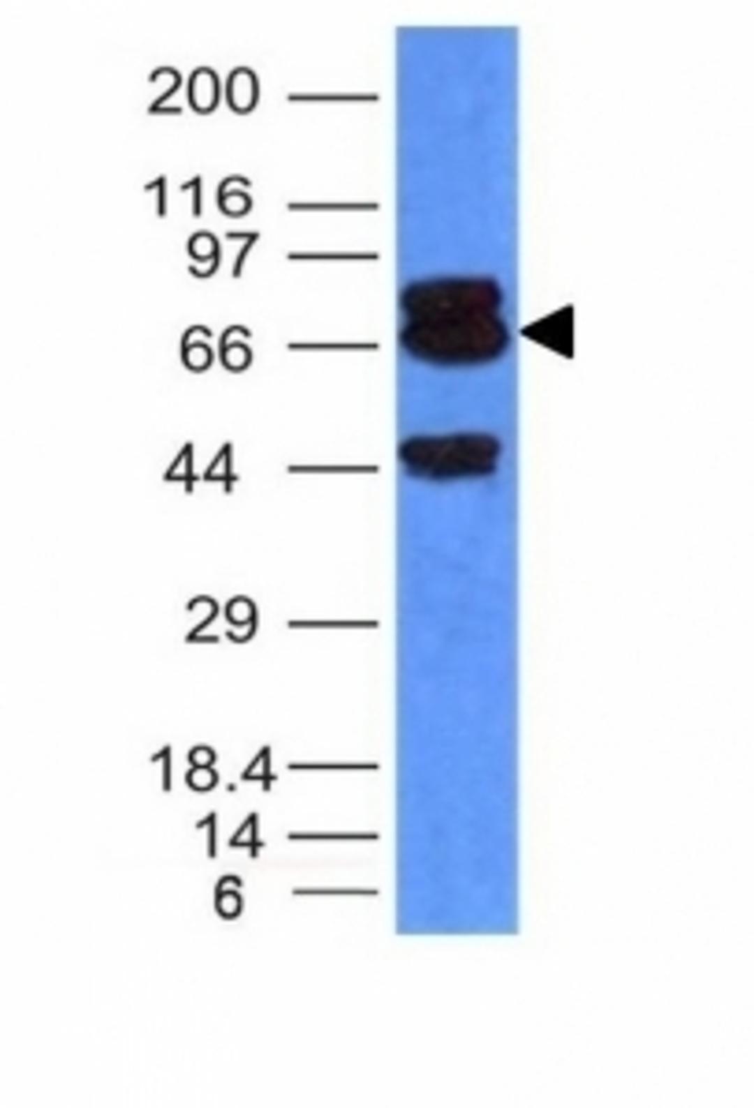 Formalin-fixed, paraffin-embedded human prostate carcinoma stained with PTEN antibody.