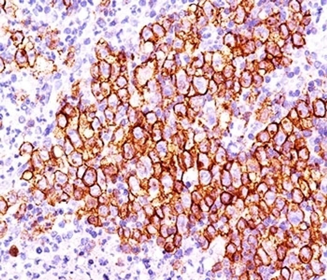 IHC testing of Hodgkin's lymphoma (20X) stained with CD30 antibody (CD30/412).