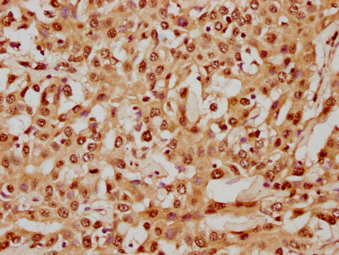 IHC image of CSB-PA010429PA05nhibHU diluted at 1:8 and staining in paraffin-embedded human liver cancer performed on a Leica BondTM system. After dewaxing and hydration, antigen retrieval was mediated by high pressure in a citrate buffer (pH 6.0). Section was blocked with 10% normal goat serum 30min at RT. Then primary antibody (1% BSA) was incubated at 4°C overnight. The primary is detected by a biotinylated secondary antibody and visualized using an HRP conjugated SP system.