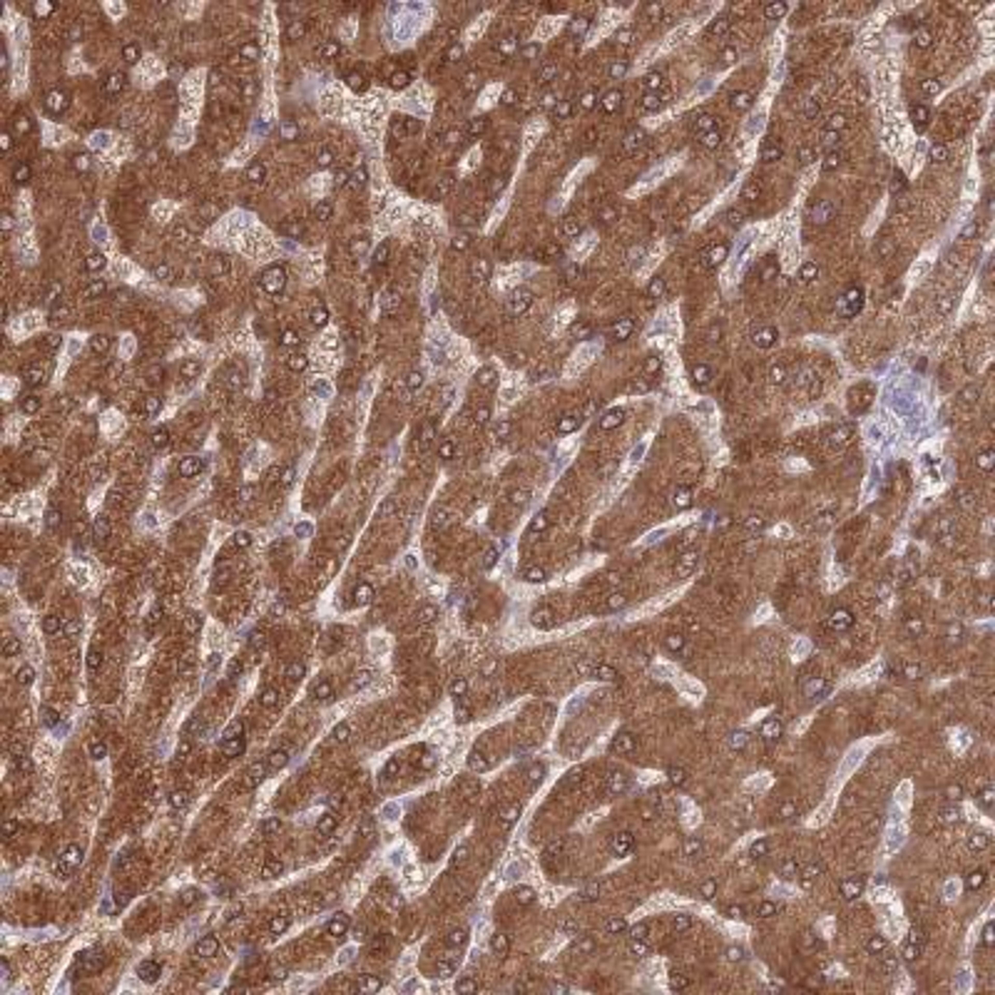 Immunohistochemistry: alcohol dehydrogenase 1A Antibody [NBP2-46756] - Analysis of human liver shows strong cytoplasmic and nuclear positivity in hepatocytes.