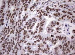 Immunohistochemistry-Paraffin: MYF-5 Antibody (OTI2G5) [NBP2-44245] - Adenocarcinoma of Human colon tissue using anti-MYF5 mouse monoclonal antibody. (Heat-induced epitope retrieval by 1 mM EDTA in 10mM Tris, pH8.5, 120C for 3min