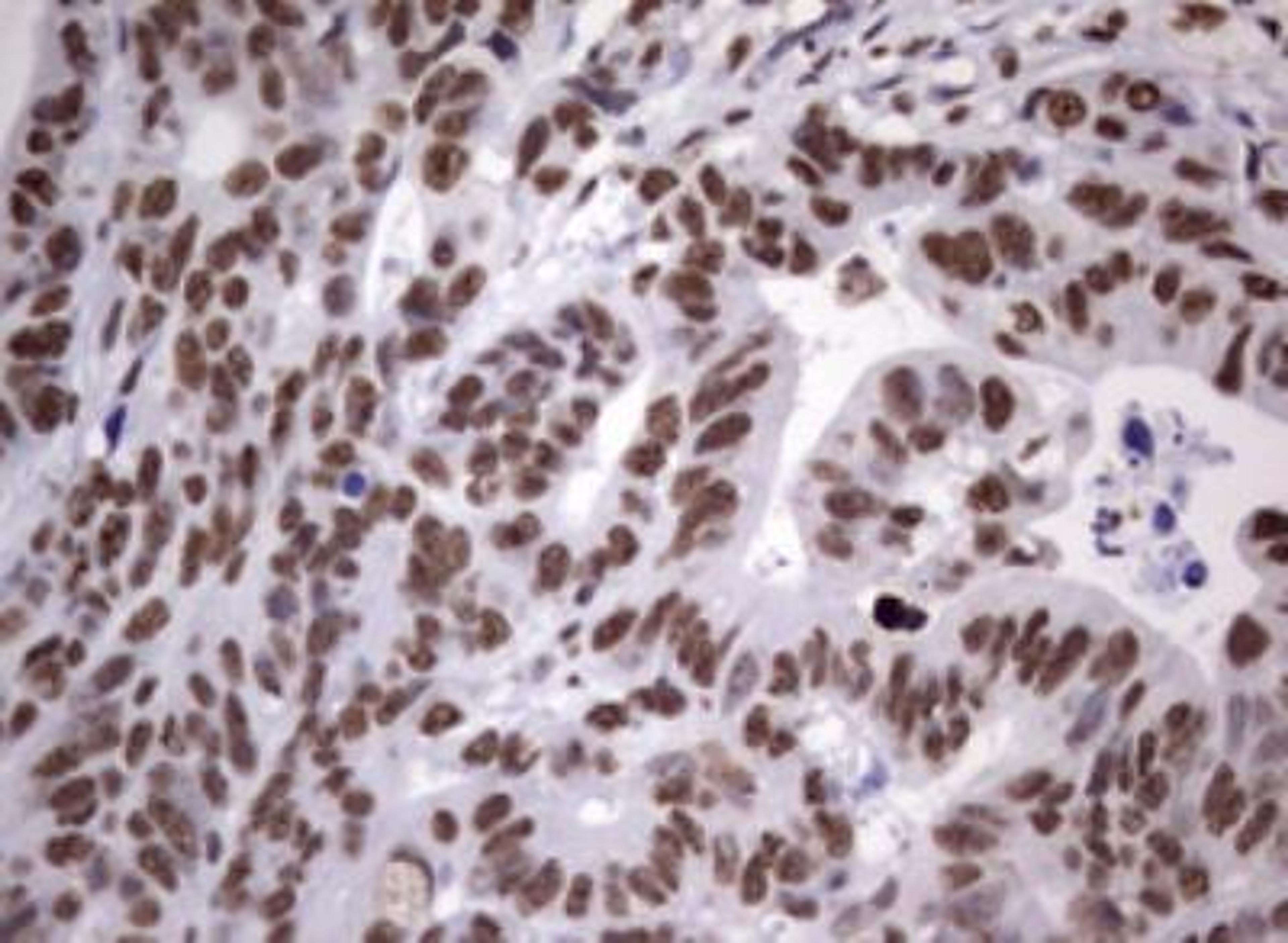 Immunohistochemistry-Paraffin: MYF-5 Antibody (OTI2G5) [NBP2-44245] - Adenocarcinoma of Human colon tissue using anti-MYF5 mouse monoclonal antibody. (Heat-induced epitope retrieval by 1 mM EDTA in 10mM Tris, pH8.5, 120C for 3min