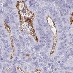 Immunohistochemistry: OR5F1 Antibody [NBP2-32453] - endometrial cancer