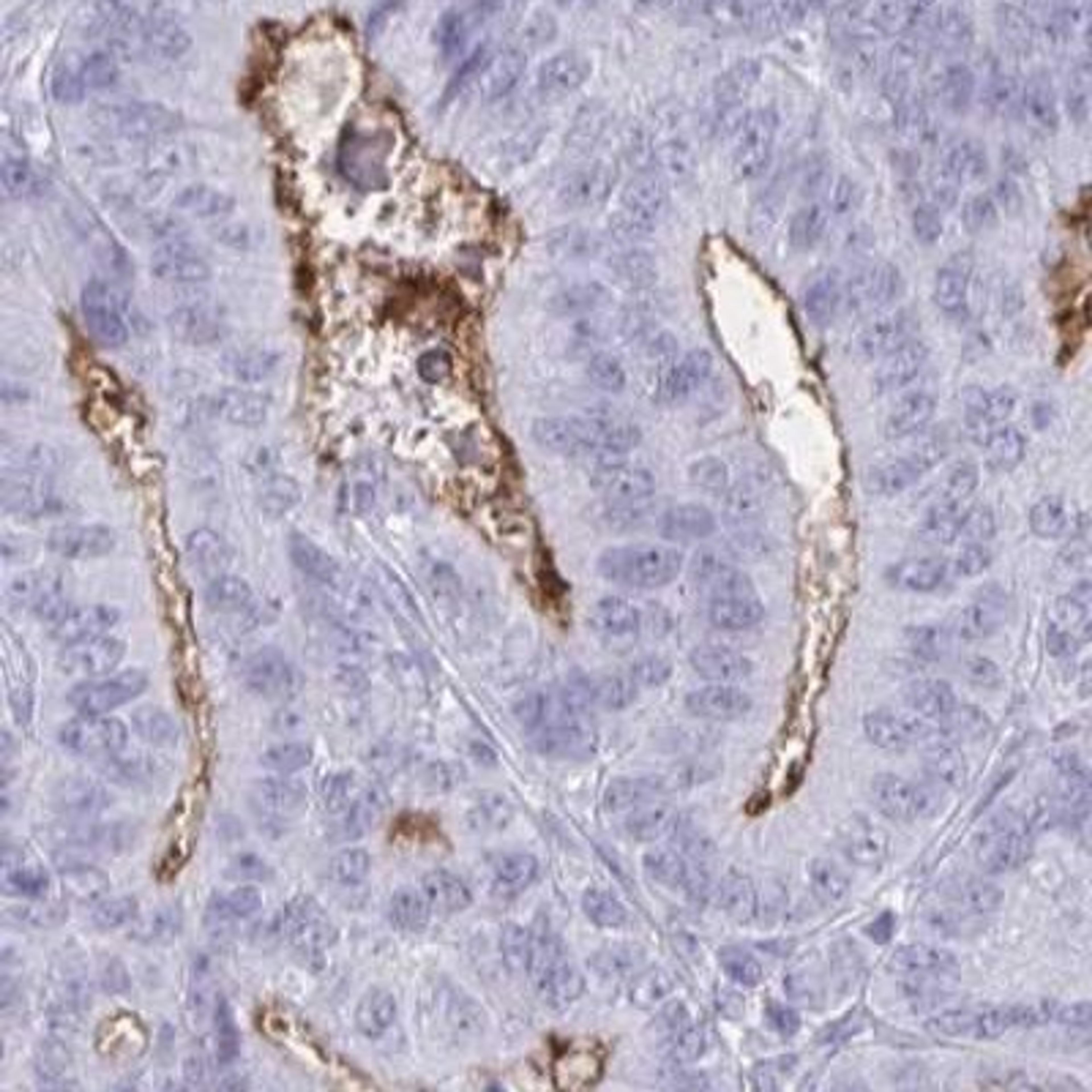 Immunohistochemistry: OR5F1 Antibody [NBP2-32453] - endometrial cancer