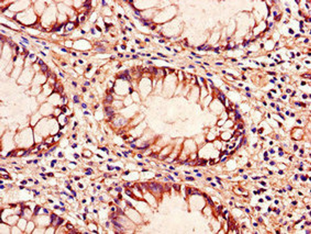 Immunohistochemistry of paraffin-embedded human colon cancer using CSB-PA023608LA01HU at dilution of 1:100
