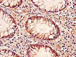 Immunohistochemistry of paraffin-embedded human colon cancer using CSB-PA023608LA01HU at dilution of 1:100