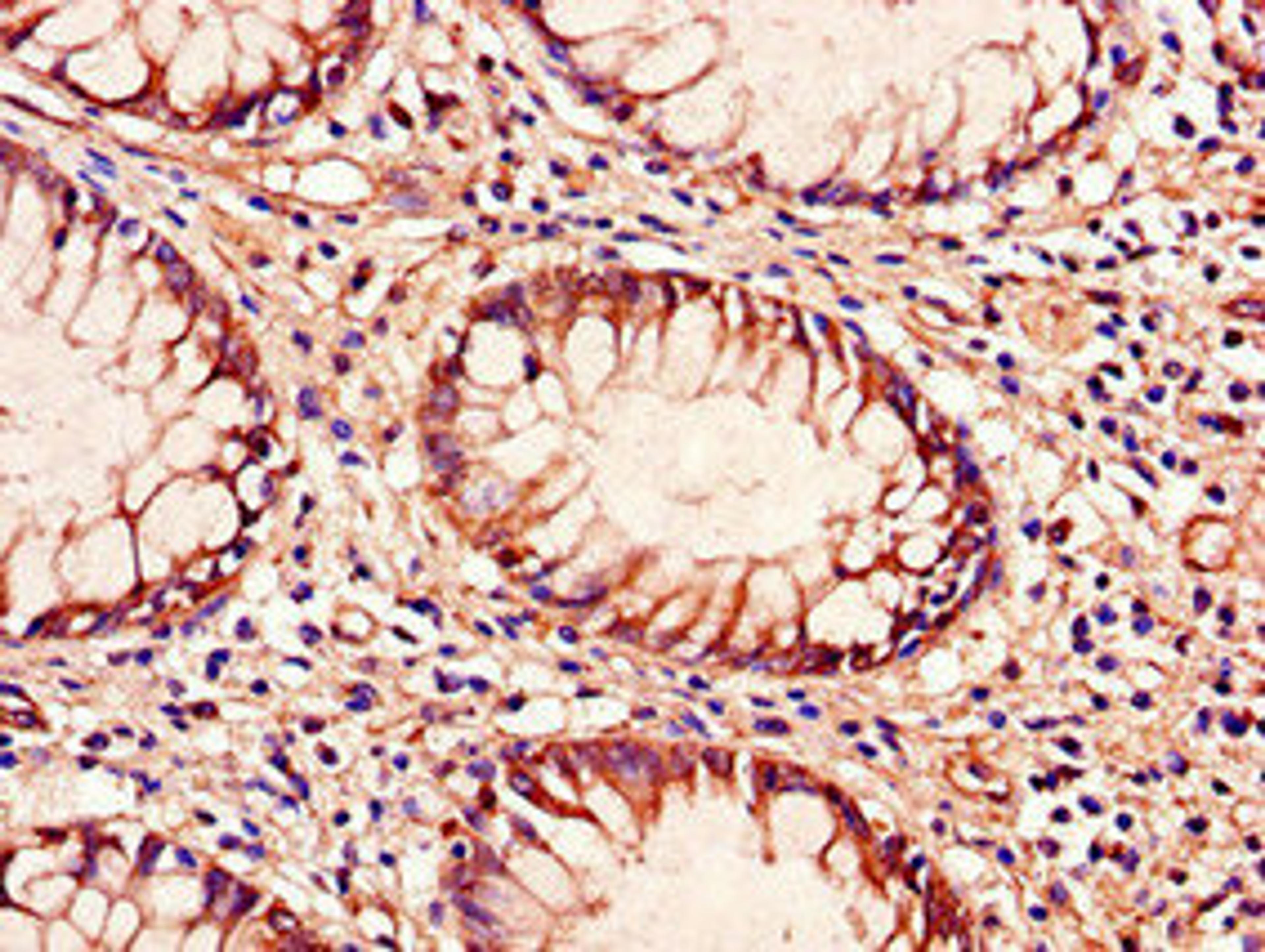 Immunohistochemistry of paraffin-embedded human colon cancer using CSB-PA023608LA01HU at dilution of 1:100
