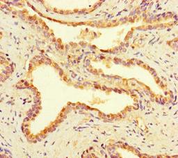 Immunohistochemistry of paraffin-embedded human prostate cancer using CSB-PA810267LA01HU at dilution of 1:100