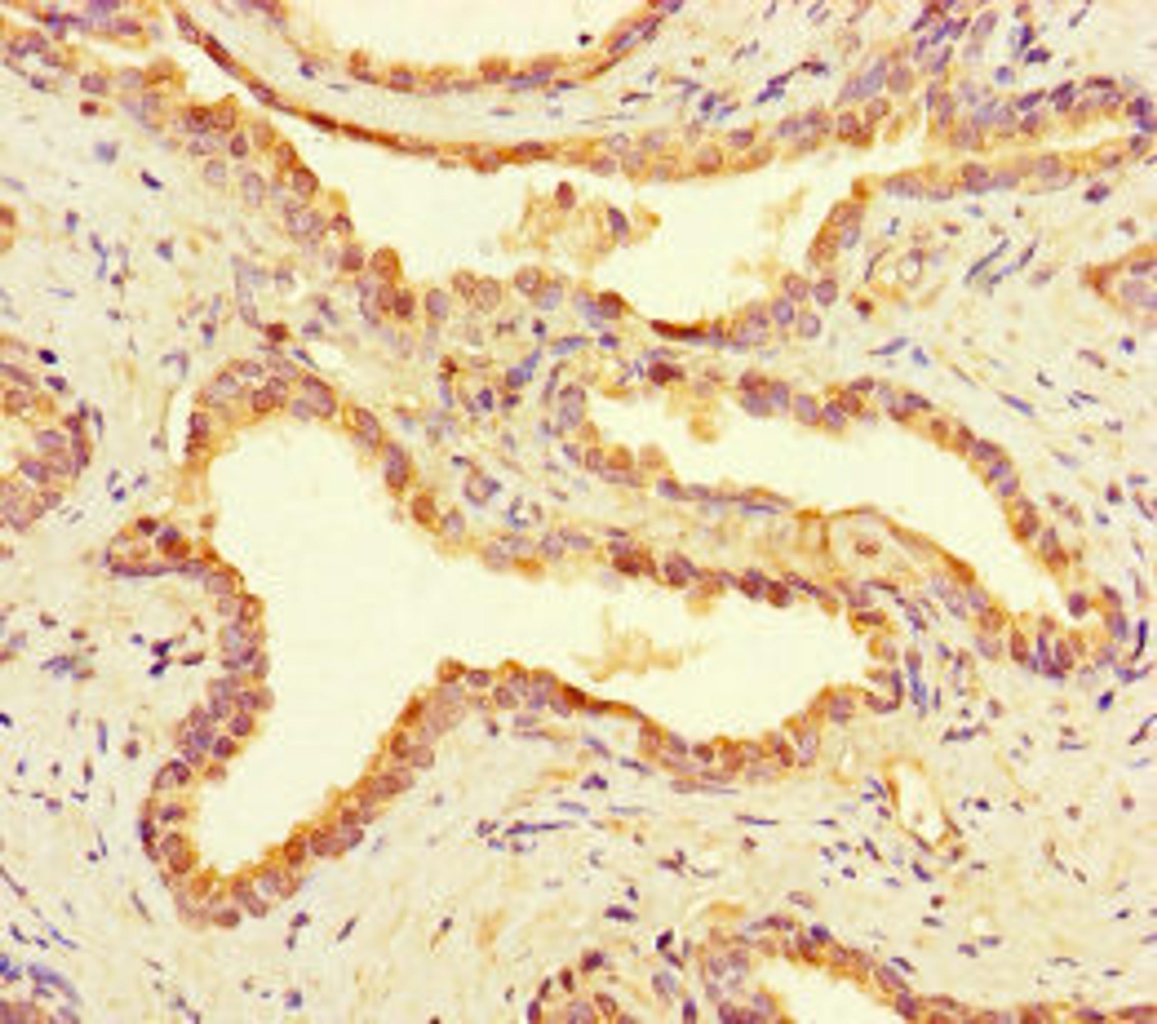 Immunohistochemistry of paraffin-embedded human prostate cancer using CSB-PA810267LA01HU at dilution of 1:100