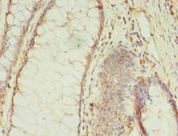 Immunohistochemistry of paraffin-embedded human colon cancer using CSB-PA875636LA01HU at dilution of 1:100