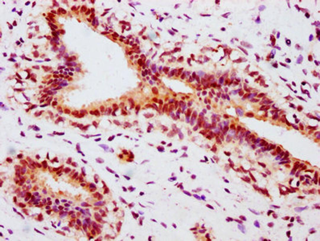 IHC image of CSB-RA007830A118phHU diluted at 1:100 and staining in paraffin-embedded human breast cancer performed on a Leica BondTM system. After dewaxing and hydration, antigen retrieval was mediated by high pressure in a citrate buffer (pH 6.0). Section was blocked with 10% normal goat serum 30min at RT. Then primary antibody (1% BSA) was incubated at 4℃ overnight. The primary is detected by a biotinylated secondary antibody and visualized using an HRP conjugated SP system.