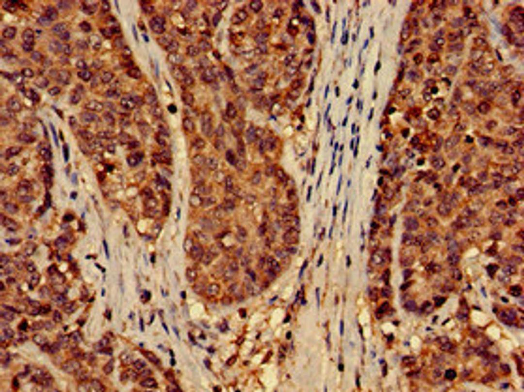 Immunohistochemistry of paraffin-embedded human ovarian cancer using CSB-PA856907LA01HU at dilution of 1:100
