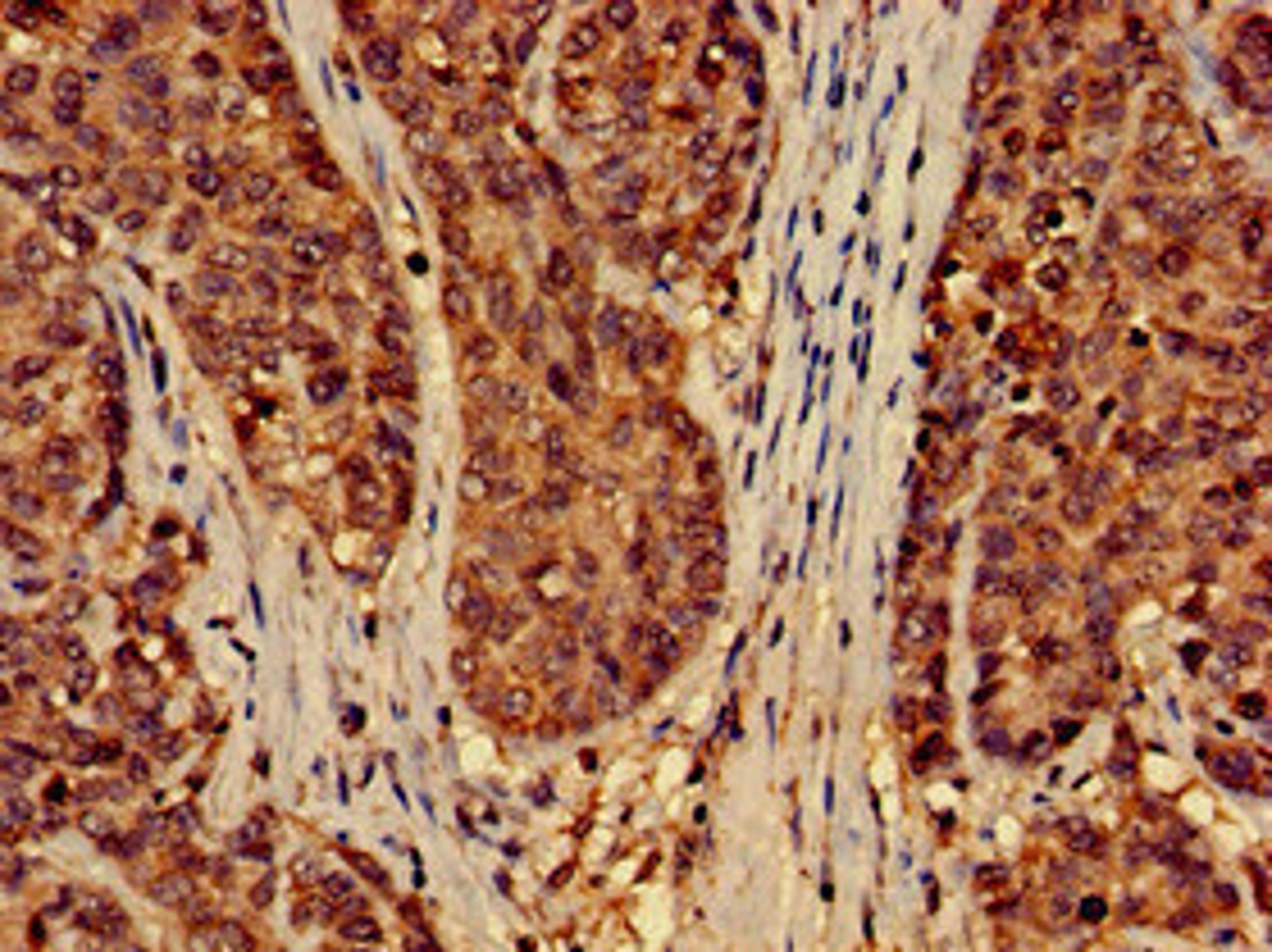 Immunohistochemistry of paraffin-embedded human ovarian cancer using CSB-PA856907LA01HU at dilution of 1:100