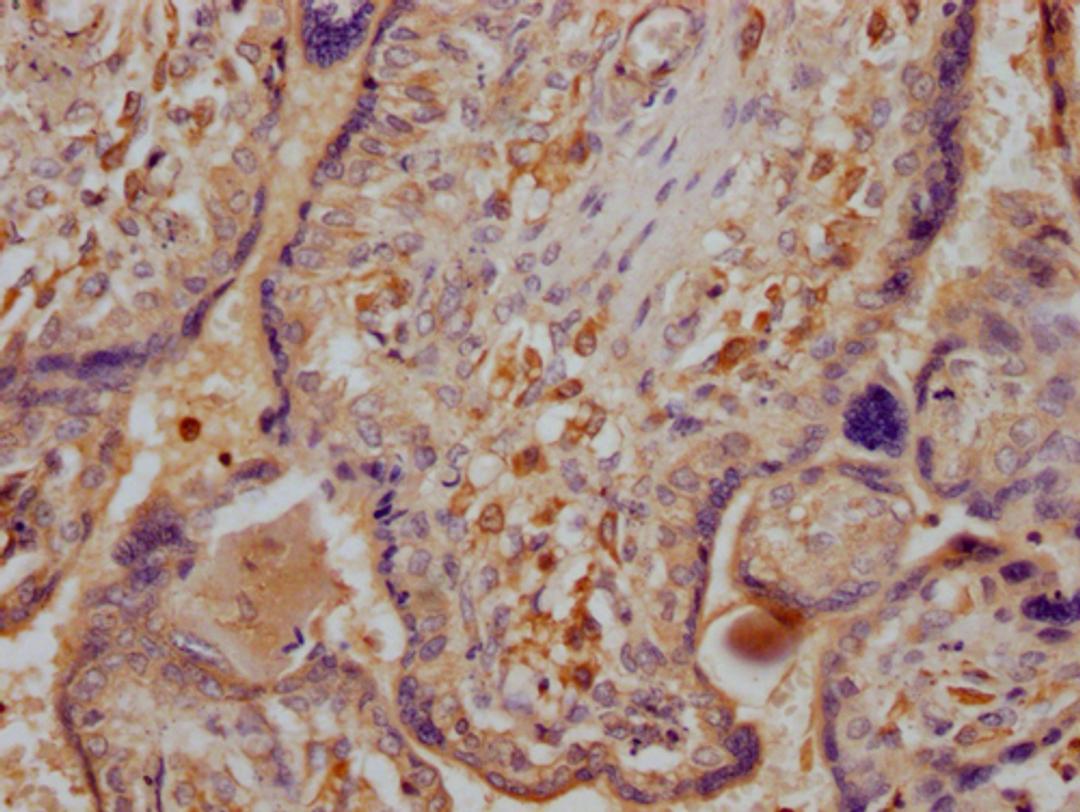 IHC image of CSB-PA892478LA01HU diluted at 1:300 and staining in paraffin-embedded human placenta tissue performed on a Leica BondTM system. After dewaxing and hydration, antigen retrieval was mediated by high pressure in a citrate buffer (pH 6.0). Section was blocked with 10% normal goat serum 30min at RT. Then primary antibody (1% BSA) was incubated at 4°C overnight. The primary is detected by a Goat anti-rabbit IgG labeled by HRP and visualized using 0.05% DAB.