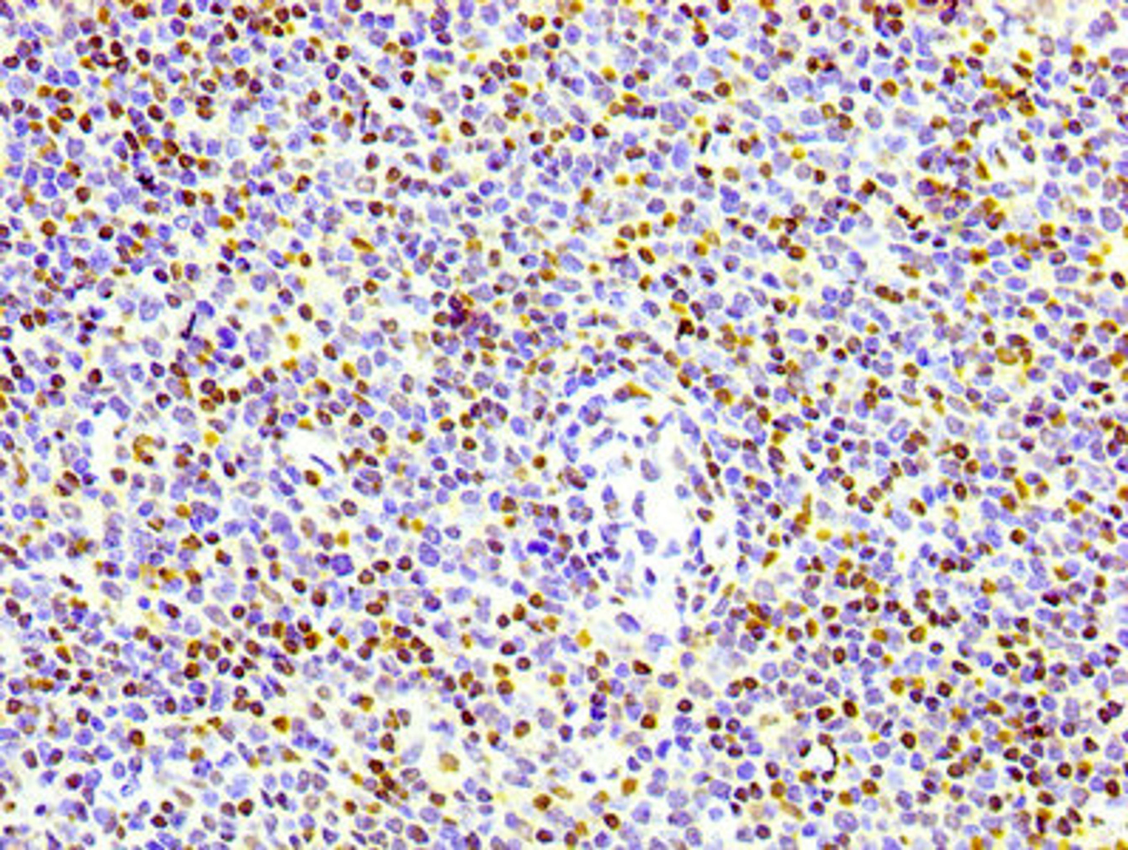 IHC image of CSB-RA010380A17phHU diluted at 1:100 and staining in paraffin-embedded human lymph node tissue performed on a Leica BondTM system. After dewaxing and hydration, antigen retrieval was mediated by high pressure in a citrate buffer (pH 6.0). Section was blocked with 10% normal goat serum 30min at RT. Then primary antibody (1% BSA) was incubated at 4℃ overnight. The primary is detected by a biotinylated secondary antibody and visualized using an HRP conjugated SP system.