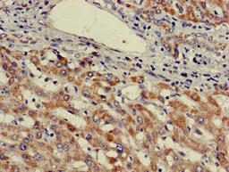 Immunohistochemistry of paraffin-embedded human liver cancer using CSB-PA025488LA01HU at dilution of 1:100