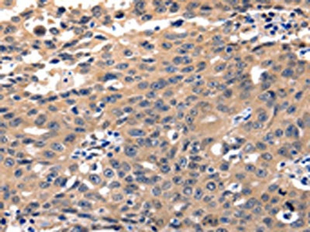 The image on the left is immunohistochemistry of paraffin-embedded Human ovarian cancer tissue using CSB-PA072462(YWHAE Antibody) at dilution 1/5, on the right is treated with fusion protein. (Original magnification: ×200)