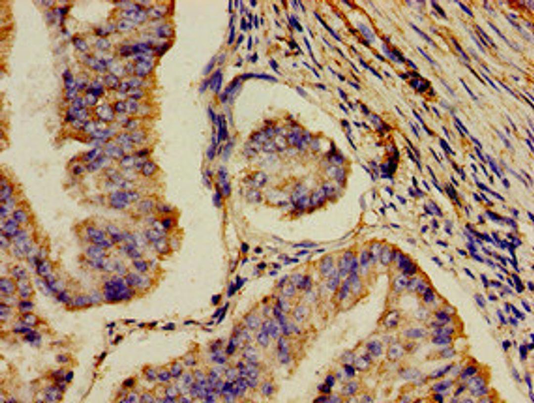 Immunohistochemistry of paraffin-embedded human endometrial cancer using CSB-PA624122LA01HU at dilution of 1:100