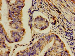 Immunohistochemistry of paraffin-embedded human endometrial cancer using CSB-PA624122LA01HU at dilution of 1:100