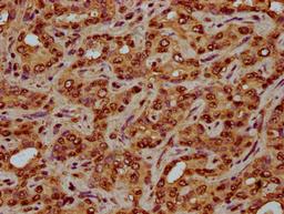 IHC image of CSB-PA010429OA05nhibHU diluted at 1:3 and staining in paraffin-embedded human liver cancer performed on a Leica BondTM system. After dewaxing and hydration, antigen retrieval was mediated by high pressure in a citrate buffer (pH 6.0). Section was blocked with 10% normal goat serum 30min at RT. Then primary antibody (1% BSA) was incubated at 4&deg;C overnight. The primary is detected by a biotinylated secondary antibody and visualized using an HRP conjugated SP system.