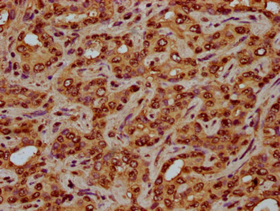 IHC image of CSB-PA010429OA05nhibHU diluted at 1:3 and staining in paraffin-embedded human liver cancer performed on a Leica BondTM system. After dewaxing and hydration, antigen retrieval was mediated by high pressure in a citrate buffer (pH 6.0). Section was blocked with 10% normal goat serum 30min at RT. Then primary antibody (1% BSA) was incubated at 4°C overnight. The primary is detected by a biotinylated secondary antibody and visualized using an HRP conjugated SP system.