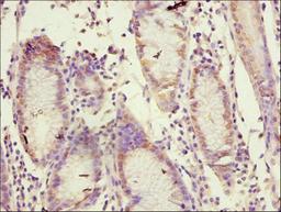 Immunohistochemistry of paraffin-embedded human gastric cancer using CSB-PA07019A0Rb at dilution of 1:100