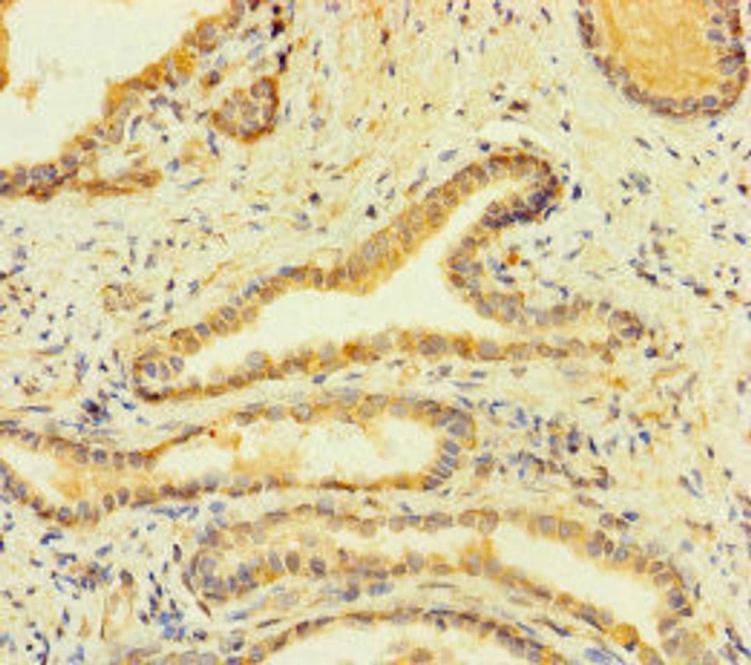 Immunohistochemistry of paraffin-embedded human prostate cancer using CSB-PA008532LA01HU at dilution of 1:100