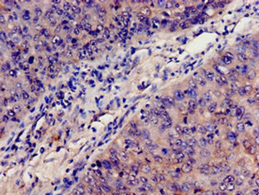 Immunohistochemistry analysis of human cervical cancer using CSB-PA10599A0Rb at dilution of 1:100