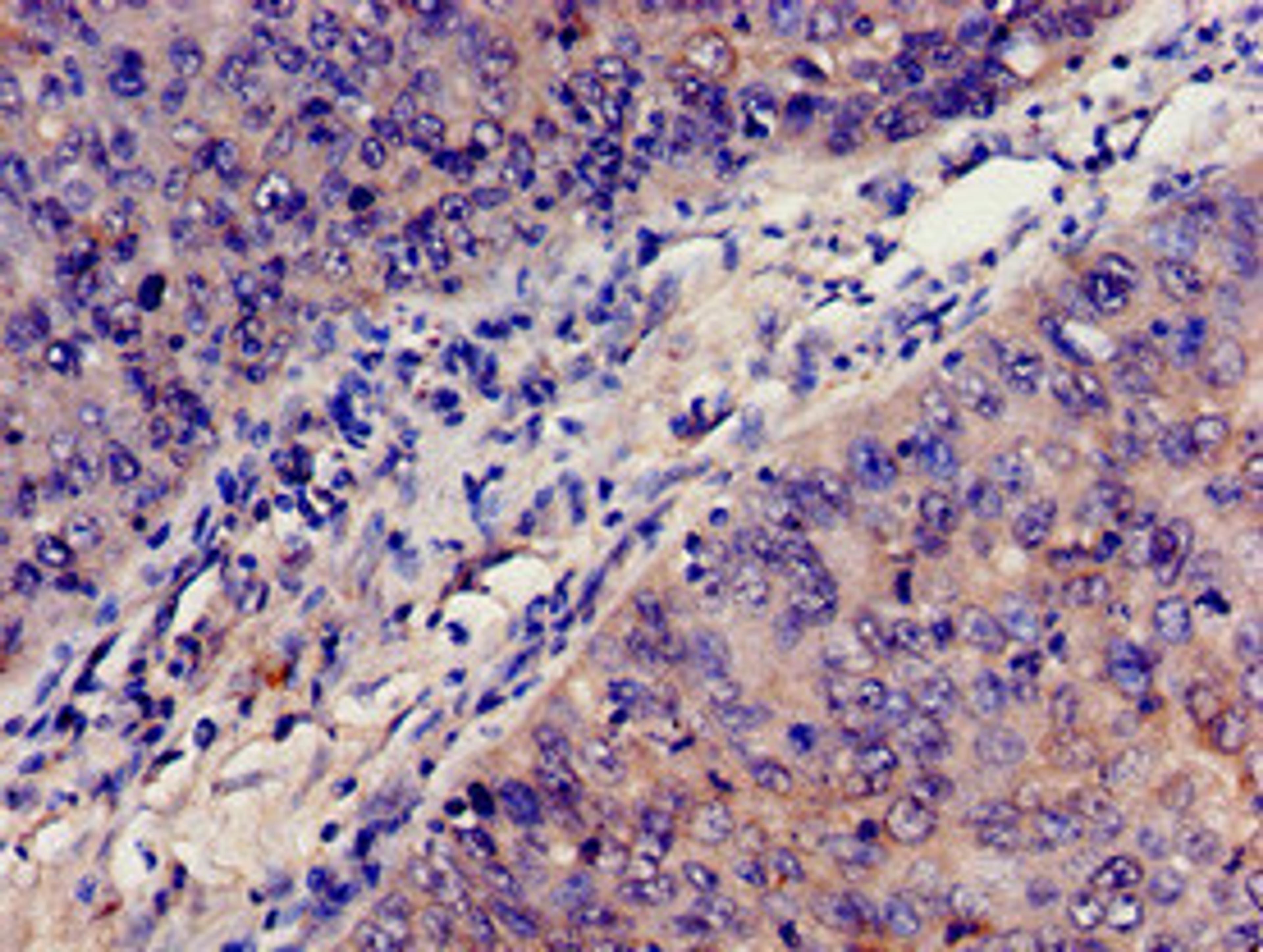 Immunohistochemistry analysis of human cervical cancer using CSB-PA10599A0Rb at dilution of 1:100