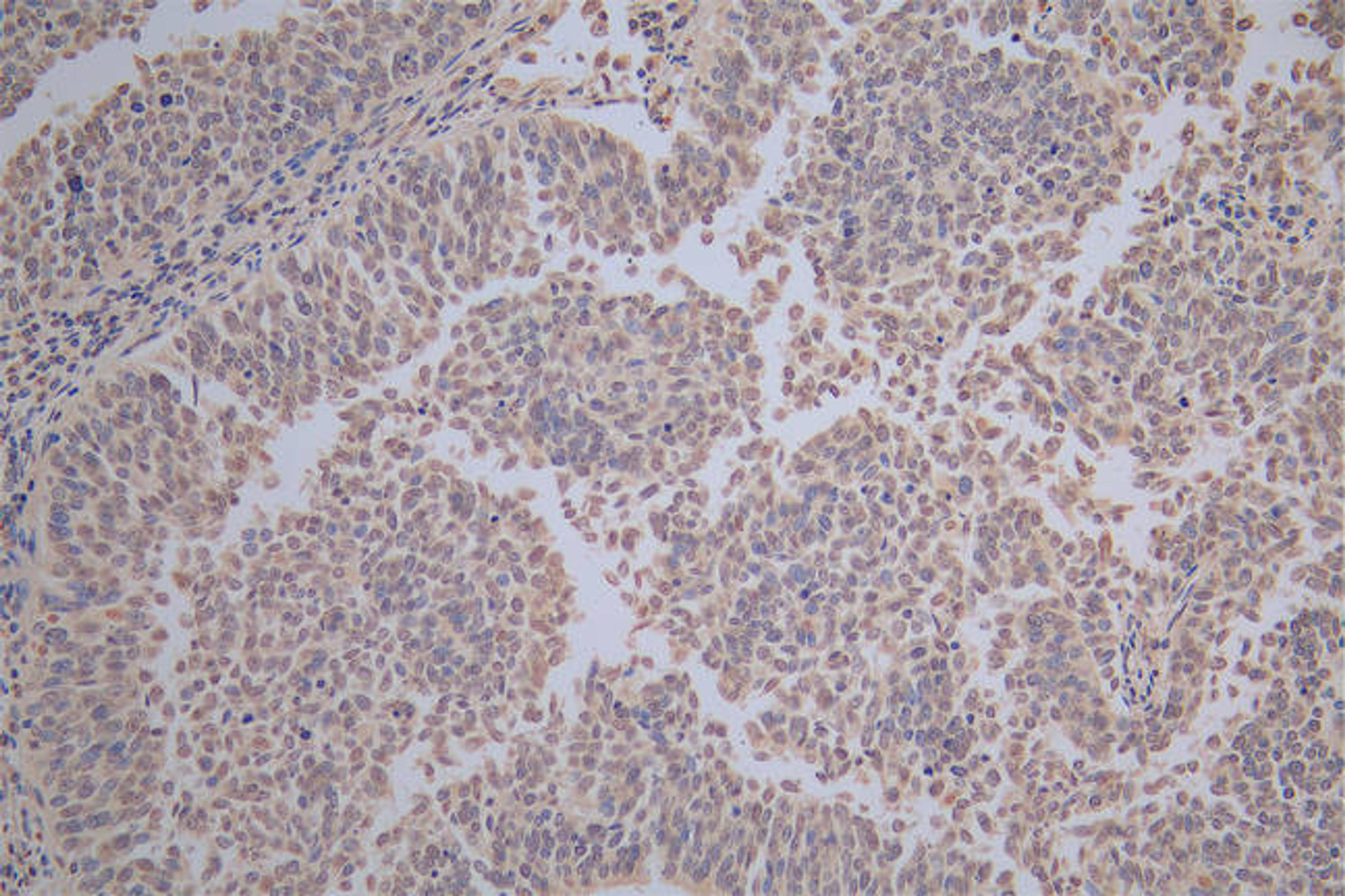 IHC image of CSB-RA010833MA1HU diluted at 1:100 and staining in paraffin-embedded human cervical cancer performed on a Leica BondTM system. After dewaxing and hydration,  antigen retrieval was mediated by high pressure in a citrate buffer (pH 6.0). Section was blocked with 10% normal goat serum 30min at RT. Then primary antibody (1% BSA) was incubated at 4°C overnight. The primary is detected by a Goat anti-Mouse IgG labeled by HRP and visualized using 0.05% DAB.