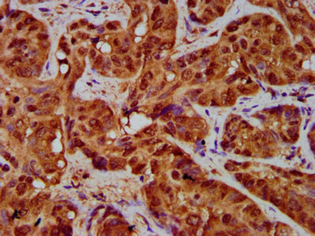 IHC image of CSB-PA14729A0Rb diluted at 1:200 and staining in paraffin-embedded human liver cancer performed on a Leica BondTM system. After dewaxing and hydration, antigen retrieval was mediated by high pressure in a citrate buffer (pH 6.0). Section was blocked with 10% normal goat serum 30min at RT. Then primary antibody (1% BSA) was incubated at 4&deg;C overnight. The primary is detected by a biotinylated secondary antibody and visualized using an HRP conjugated SP system.