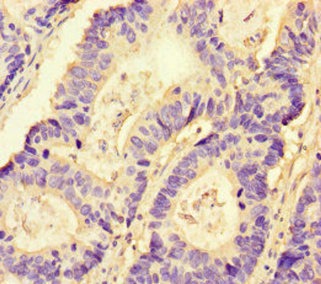 Immunohistochemistry of paraffin-embedded human colon cancer using CSB-PA016092LA01HU at dilution of 1:100