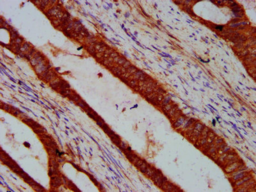 IHC image of CSB-PA768235LA01HU diluted at 1:600 and staining in paraffin-embedded human colon cancer performed on a Leica BondTM system. After dewaxing and hydration, antigen retrieval was mediated by high pressure in a citrate buffer (pH 6.0). Section was blocked with 10% normal goat serum 30min at RT. Then primary antibody (1% BSA) was incubated at 4&deg;C overnight. The primary is detected by a biotinylated secondary antibody and visualized using an HRP conjugated SP system.
