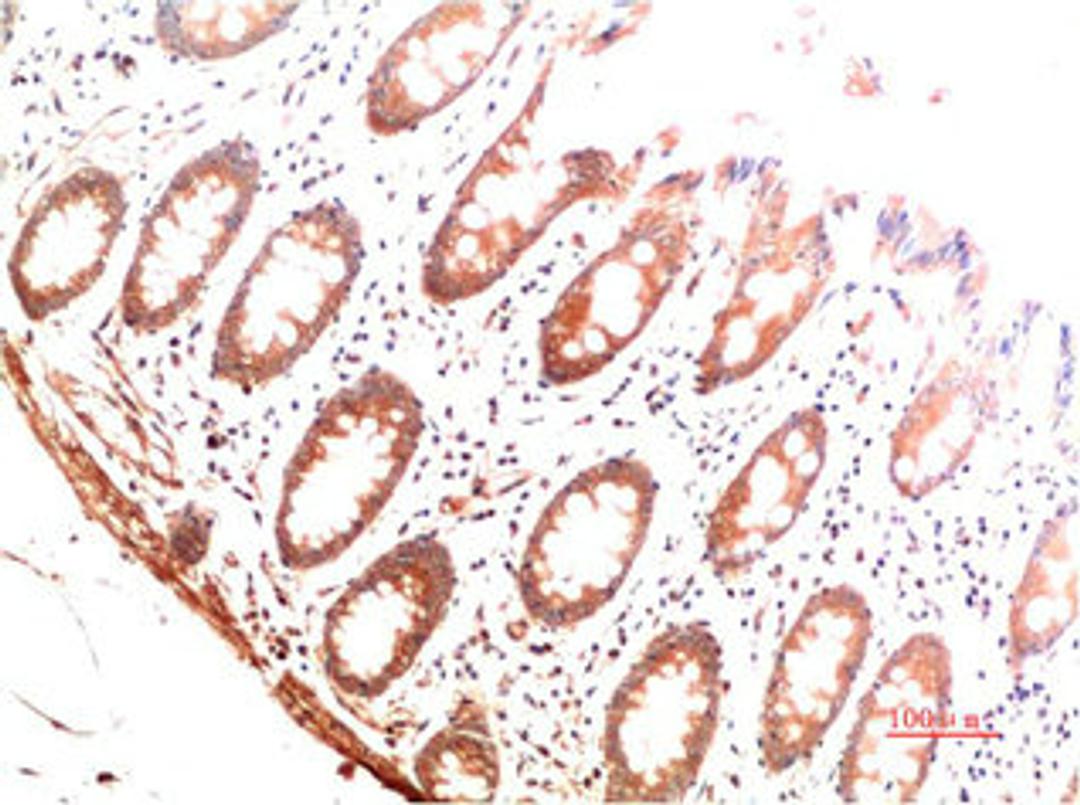 Immunohistochemical analysis of paraffin-embedded Human Colon Carcinoma Tissue using Collagen I  Mouse mAb diluted at 1:200.