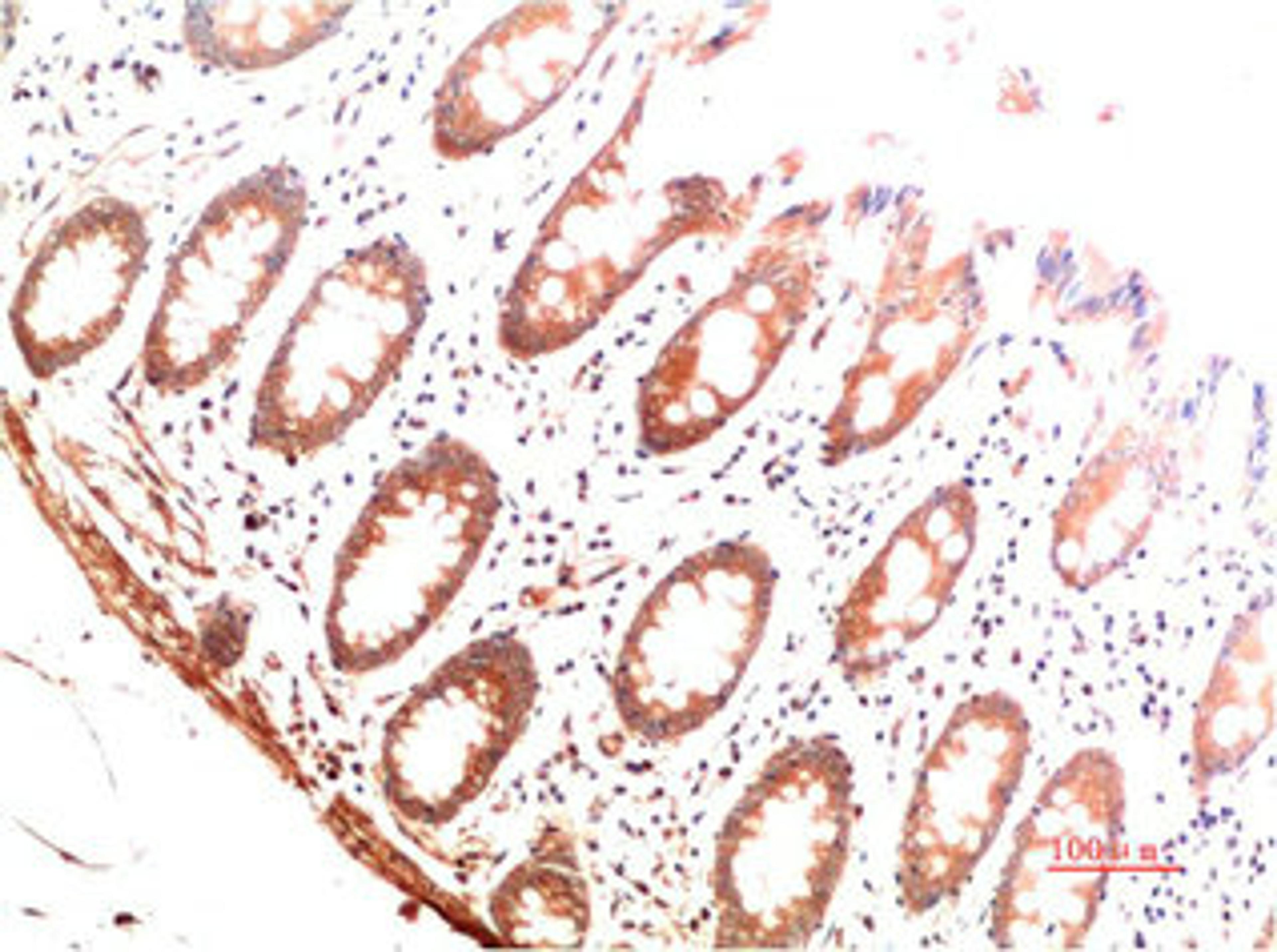 Immunohistochemical analysis of paraffin-embedded Human Colon Carcinoma Tissue using Collagen I  Mouse mAb diluted at 1:200.