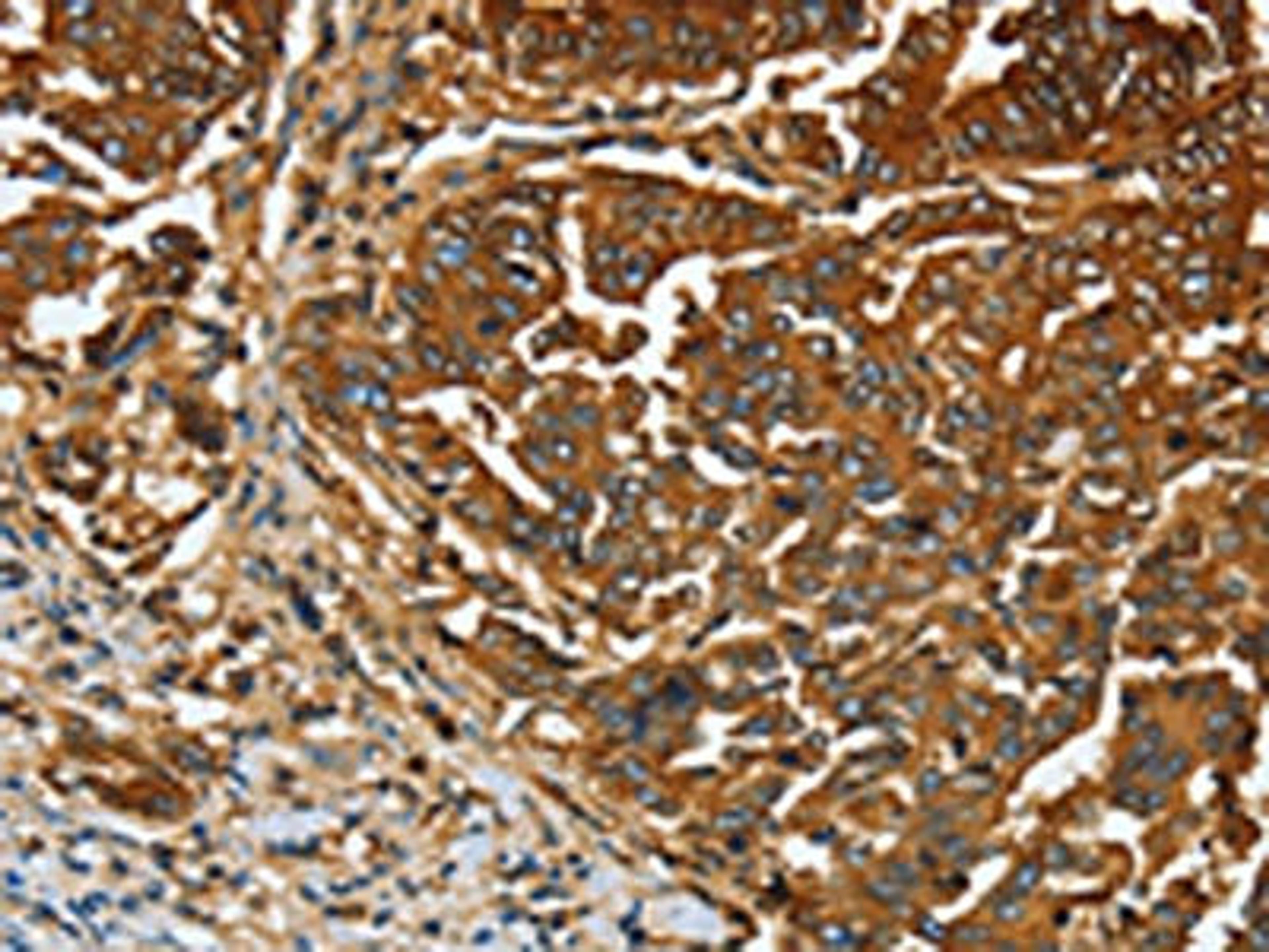 The image on the left is immunohistochemistry of paraffin-embedded Human gastic cancer tissue using CSB-PA160116(CEACAM5 Antibody) at dilution 1/20, on the right is treated with fusion protein. (Original magnification: ×200)