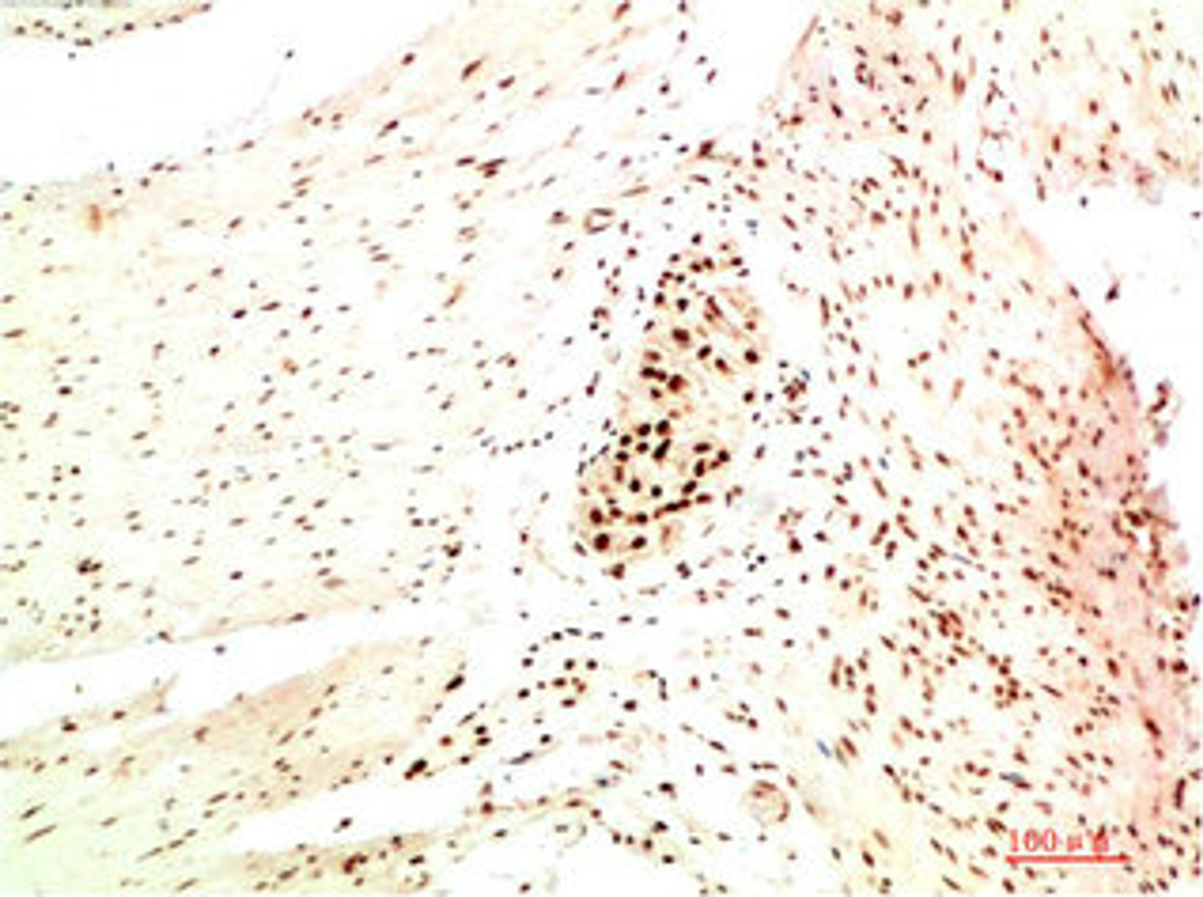 Immunohistochemical analysis of paraffin-embedded Human Colon Carcinoma Tissue using HP-1 α  Mouse mAb diluted at 1:200.