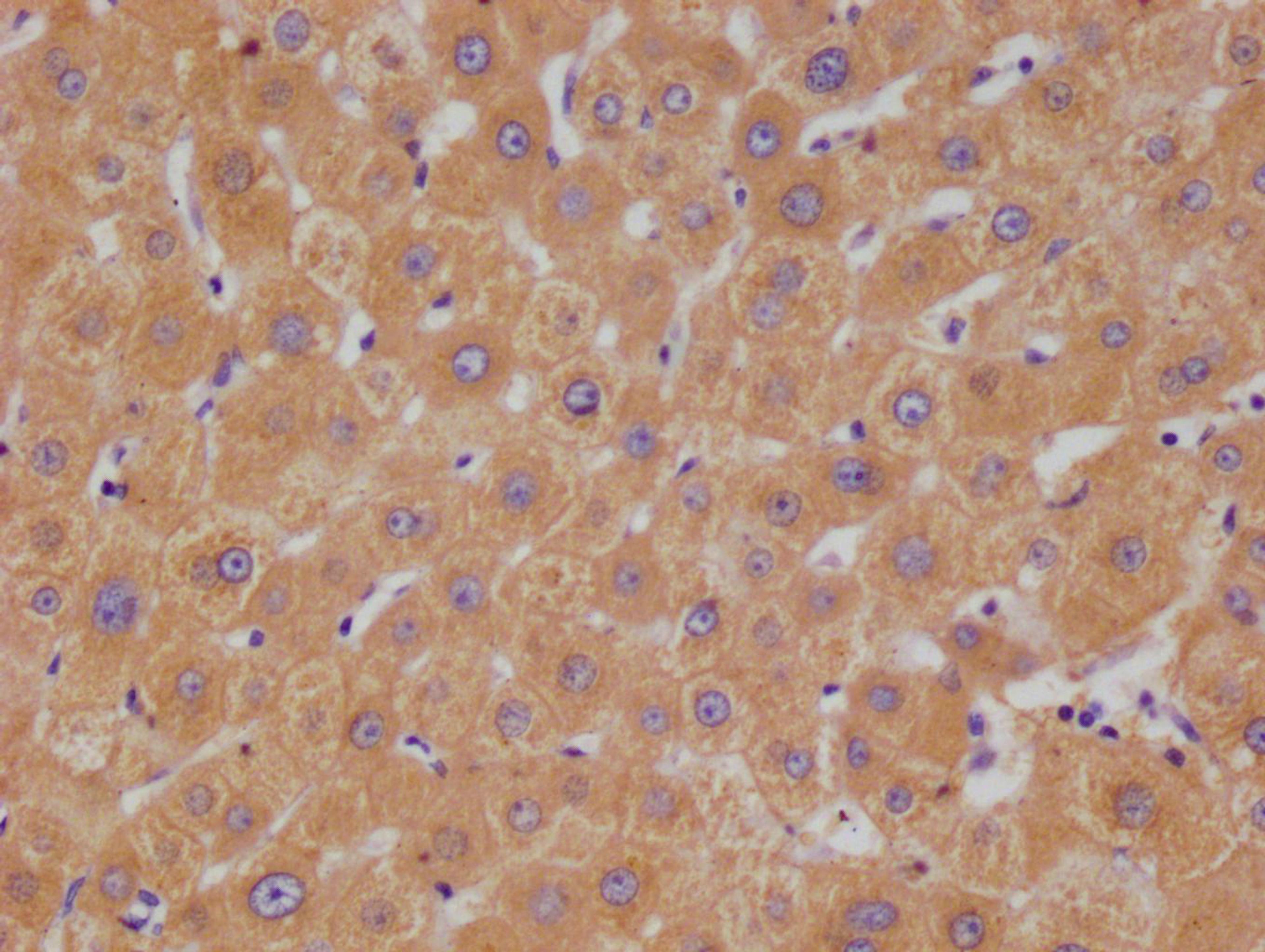 IHC image of CSB-RA695552A0HU diluted at 1:100 and staining in paraffin-embedded human liver cancer performed on a Leica BondTM system. After dewaxing and hydration, antigen retrieval was mediated by high pressure in a citrate buffer (pH 6.0). Section was blocked with 10% normal goat serum 30min at RT. Then primary antibody (1% BSA) was incubated at 4°C overnight. The primary is detected by a Goat anti-rabbit polymer IgG labeled by HRP and visualized using 0.05% DAB.