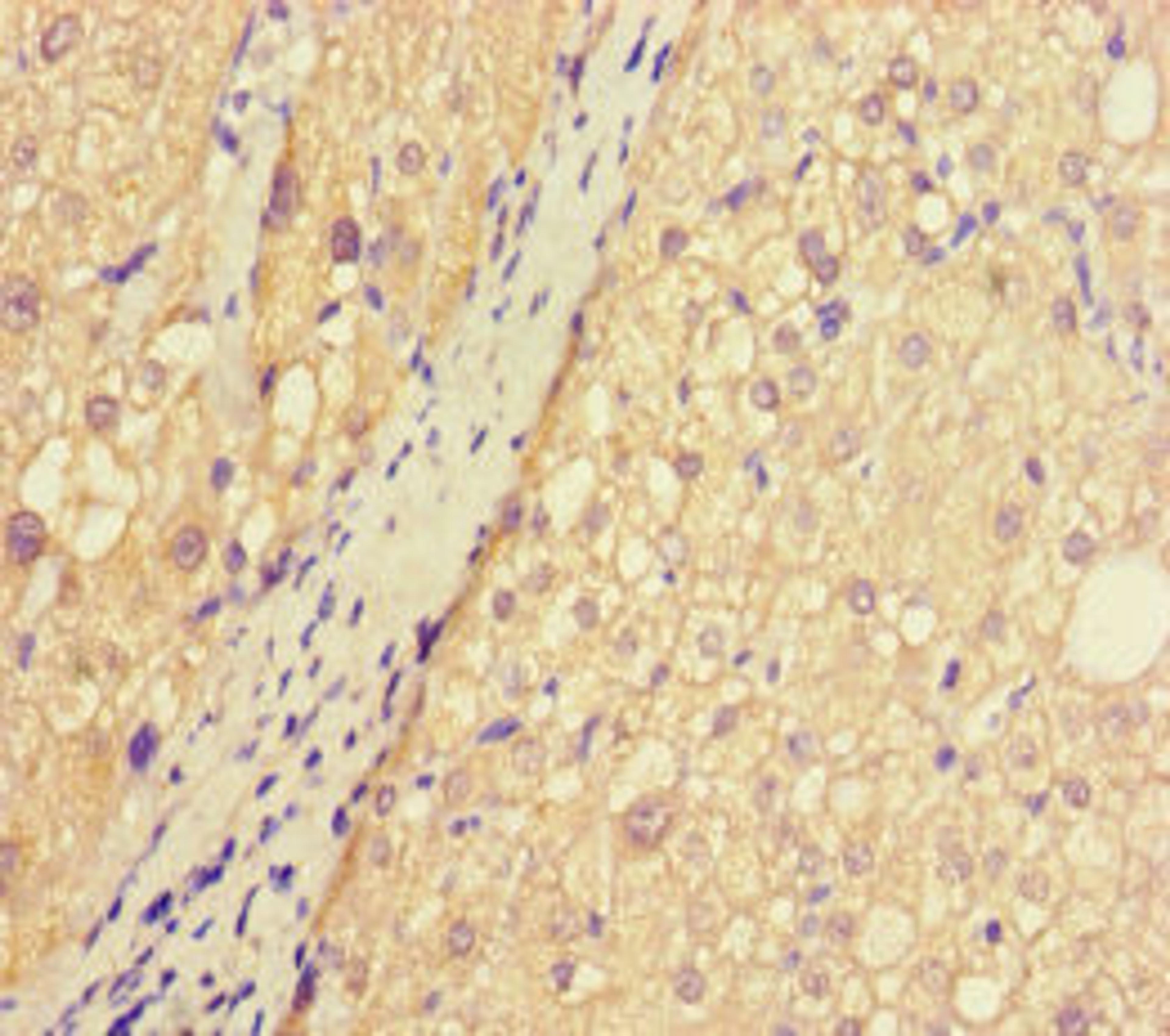 Immunohistochemistry of paraffin-embedded human liver cancer using CSB-PA845168LA01HU at dilution of 1:100