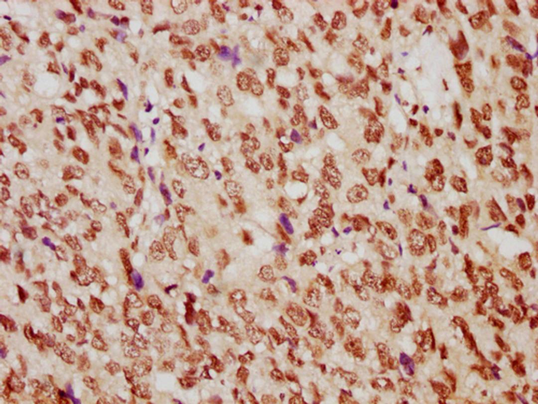 IHC image of CSB-PA010389PA29nme1HU diluted at 1:10 and staining in paraffin-embedded human ovarian cancer performed on a Leica BondTM system. After dewaxing and hydration, antigen retrieval was mediated by high pressure in a citrate buffer (pH 6.0). Section was blocked with 10% normal goat serum 30min at RT. Then primary antibody (1% BSA) was incubated at 4°C overnight. The primary is detected by a biotinylated secondary antibody and visualized using an HRP conjugated SP system.