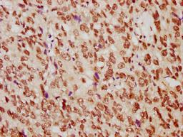 IHC image of CSB-PA010389PA29nme1HU diluted at 1:10 and staining in paraffin-embedded human ovarian cancer performed on a Leica BondTM system. After dewaxing and hydration, antigen retrieval was mediated by high pressure in a citrate buffer (pH 6.0). Section was blocked with 10% normal goat serum 30min at RT. Then primary antibody (1% BSA) was incubated at 4°C overnight. The primary is detected by a biotinylated secondary antibody and visualized using an HRP conjugated SP system.