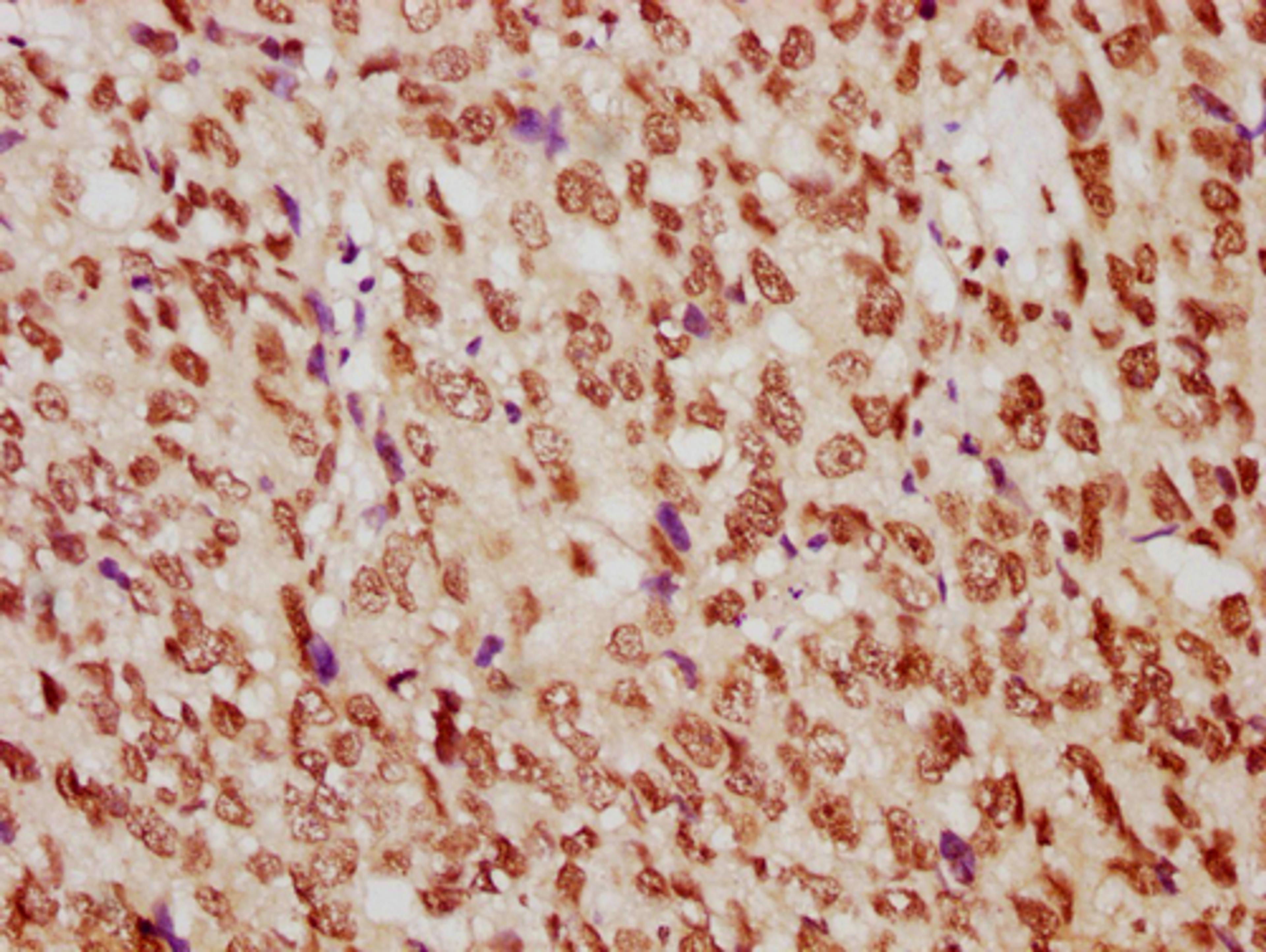 IHC image of CSB-PA010389PA29nme1HU diluted at 1:10 and staining in paraffin-embedded human ovarian cancer performed on a Leica BondTM system. After dewaxing and hydration, antigen retrieval was mediated by high pressure in a citrate buffer (pH 6.0). Section was blocked with 10% normal goat serum 30min at RT. Then primary antibody (1% BSA) was incubated at 4°C overnight. The primary is detected by a biotinylated secondary antibody and visualized using an HRP conjugated SP system.