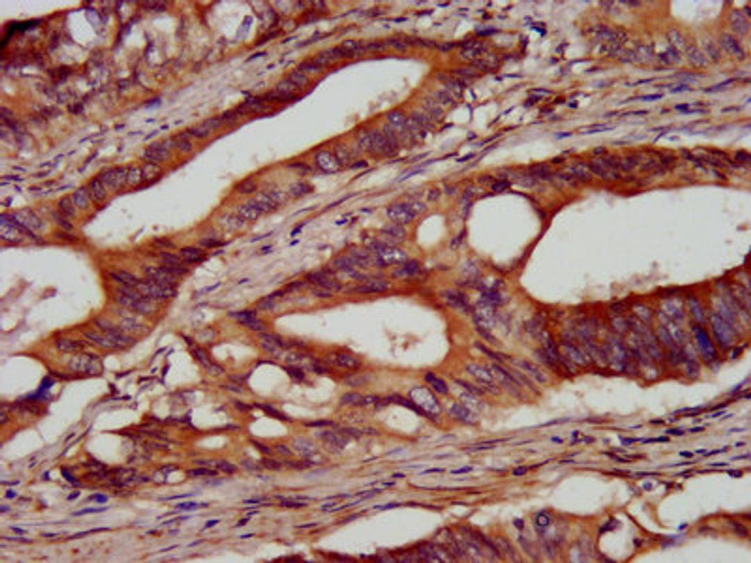 IHC image of CSB-PA866208LA01HU diluted at 1:100 and staining in paraffin-embedded human colon cancer performed on a Leica BondTM system. After dewaxing and hydration, antigen retrieval was mediated by high pressure in a citrate buffer (pH 6.0). Section was blocked with 10% normal goat serum 30min at RT. Then primary antibody (1% BSA) was incubated at 4&deg;C overnight. The primary is detected by a biotinylated secondary antibody and visualized using an HRP conjugated SP system.